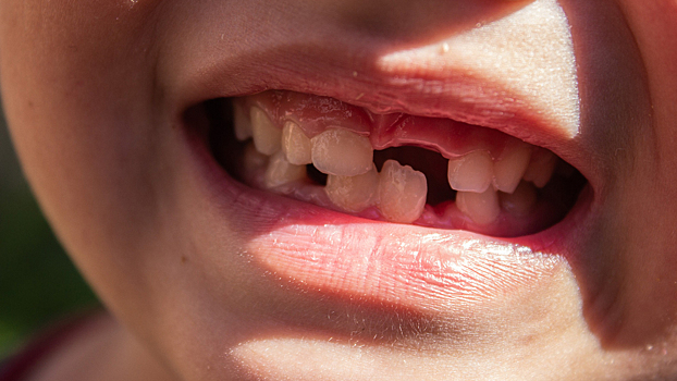 Стоматолог рассказал, можно ли спасти выбитый молочный зуб