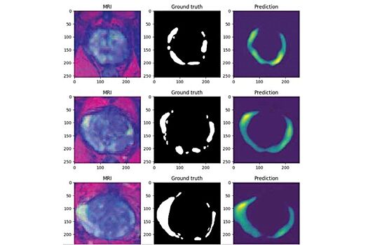 В больницах Ростова внедрили ИИ, способный выявить самый распространенный вид онкозаболевания у мужчин