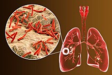 Российские ученые проводят испытания новой вакцины от туберкулеза