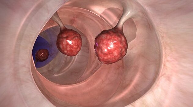 Смертность от рака кишечника в Австрии снизилась за 10 лет на 30%