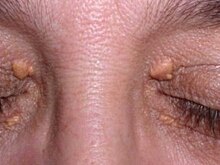 Названы кожные симптомы, указывающие на диабет второго типа