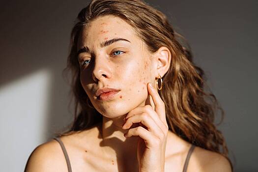 Россиян предупредили о серьезной угрозе здоровью из-за выдавливания прыщей