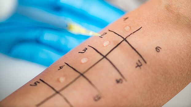 Врач рассказал, какая аллергия может пройти с возрастом