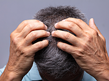 Врач рассказала, о каких заболеваниях может говорить перхоть