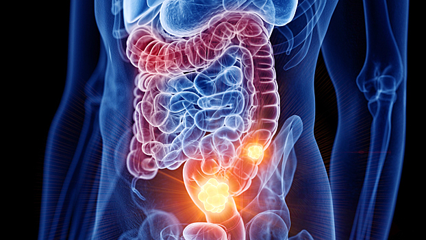 Как не пропустить колоректальный рак на ранней стадии