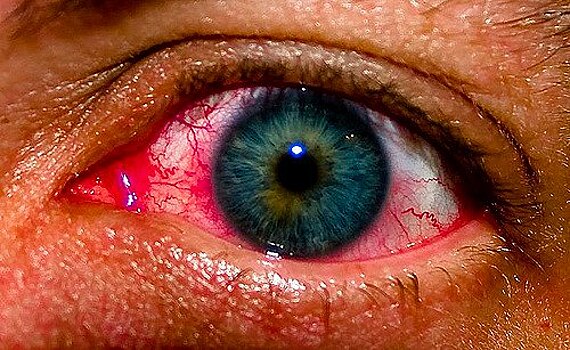 Симптомы и лечение сенной лихорадки