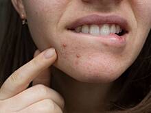 Назван быстрый способ избавиться от прыщей накануне праздника