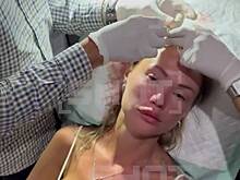 Россиянка оглохла после удара бутылкой по голове на Бали