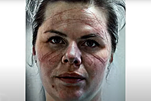 Российские медики показали пролежни и раны от многочасовых смен в масках