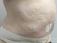 Нижегородские хирурги удалили более 7 кг кожи и жира с живота пациентки