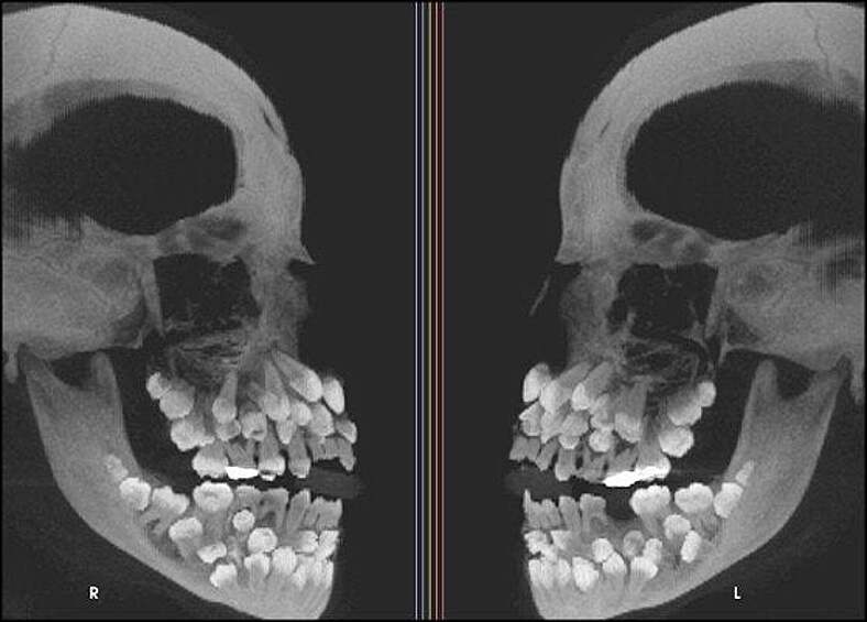 Так выглядит череп человека с аномально большим количеством зубов. 