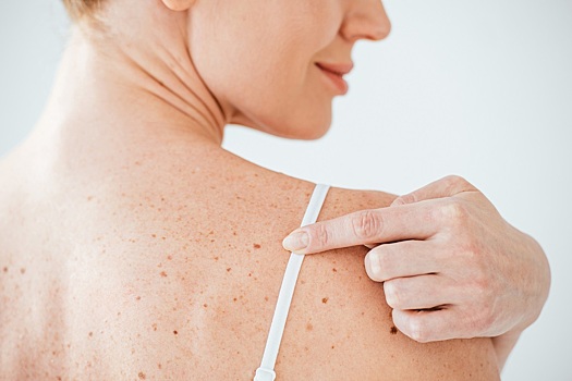 Прорыв в диагностике рака кожи: изобретены пластыри для раннего выявления злокачественных родинок