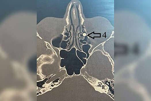 В Воронеже врачи извлекли пулю из мужчины, которому прострелили глаз