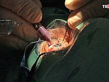 В МГУ придумали уникальный метод лечения отслоения сетчатки глаза