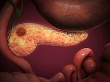 Выявлена неожиданная «помеха» в лечении рака поджелудочной