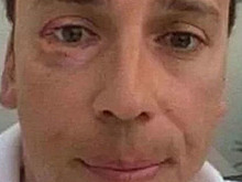 Галкину подбили глаз яблоком в Израиле за слова в адрес россиян