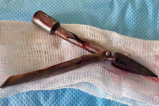 В Набережных Челнах врачи достали из головы мужчины наконечник ружья