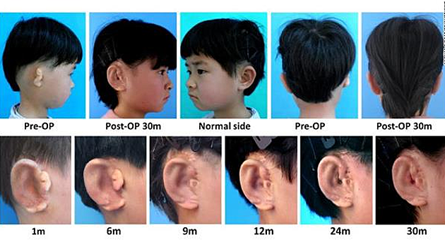 Китайские ученые напечатали детские уши на 3D-принтере