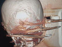 Житель Новосибирска попал в больницу с вилами в голове