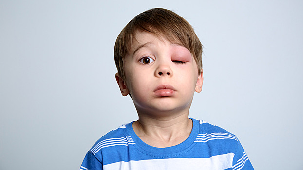 Отёк Квинке у детей: что нужно знать каждому родителю