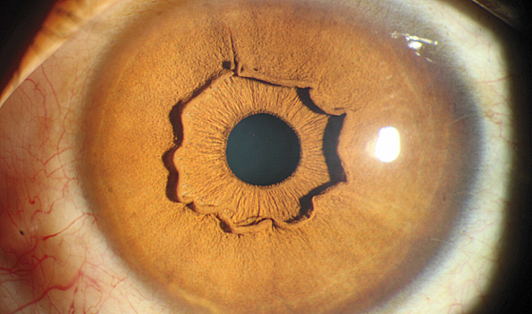 Выпячивание сетчатки: загадочный феномен деформации глаза