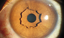 Выпячивание сетчатки: загадочный феномен деформации глаза