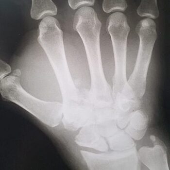 Врачи Красногорской больницы № 1 спасли пациента с множественными переломами руки