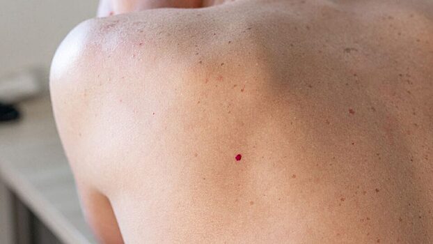 Сосудистые «звездочки» могут говорить о рубцах на печени