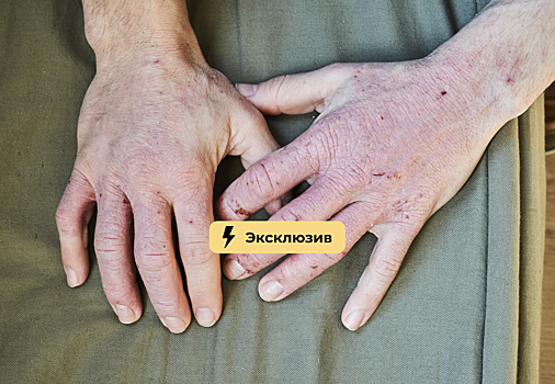 Прыщи возвращаются: как избежать обострения кожных болезней летом. Советы по уходу и питанию
