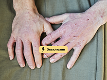 Прыщи возвращаются: как избежать обострения кожных болезней летом. Советы по уходу и питанию