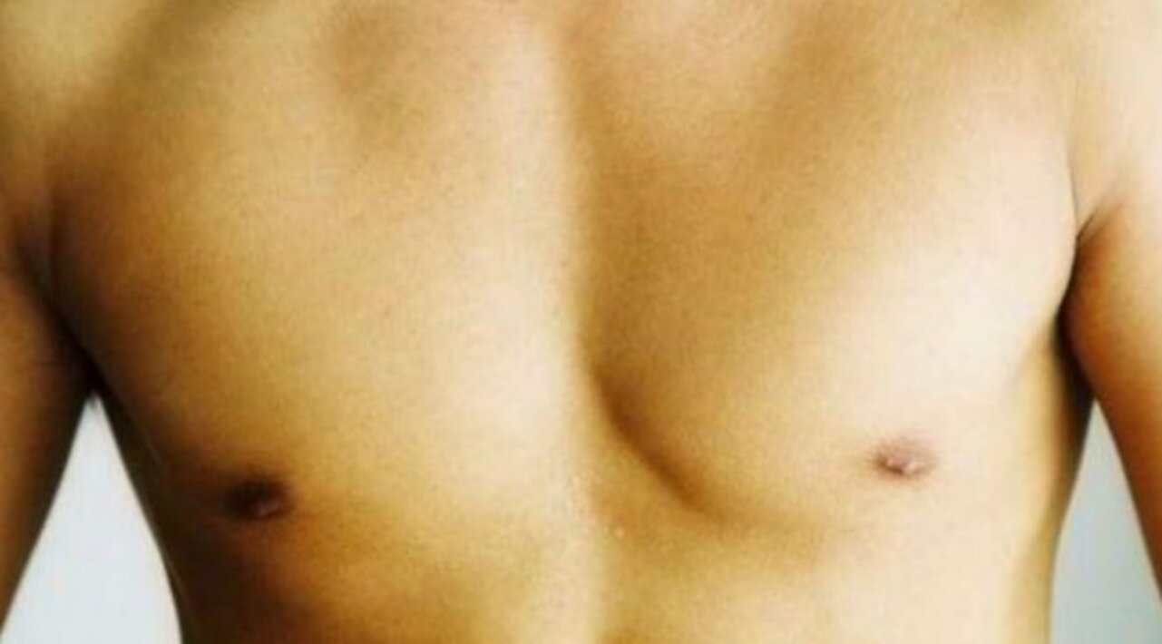 у мужчины возле соска. гинекомастия липосакция. мужская грудная железа. мужские волосатые соски. пролактиновая гинекомастия.