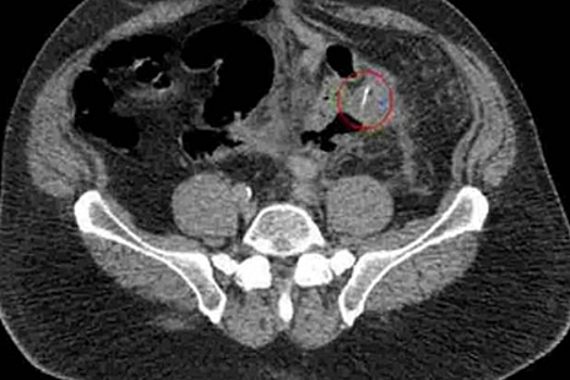 Мужчина дважды проколол кишечник одной и той же куриной костью