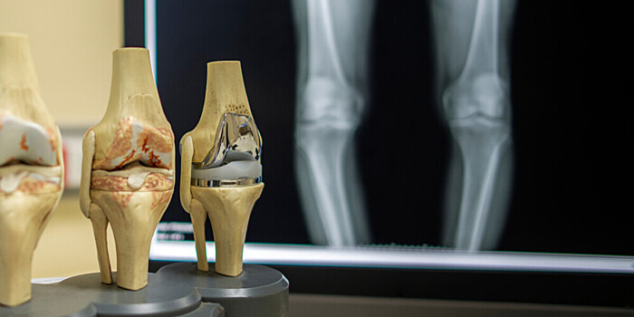 Новый метод лечения коленного сустава разработали в России
