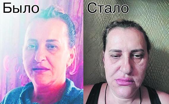 После «уколов красоты» 47-летняя курянка Олеся Леонова вынуждена проходить дорогостоящее лечение