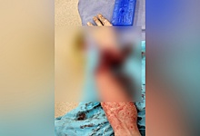 44-летнему нижегородцу врачи спасли отпиленную руку