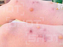 SHOT: тигровые комары не дают россиянам спокойно отдыхать на Гоа