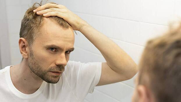 Какие бывают виды алопеции и как ее лечить