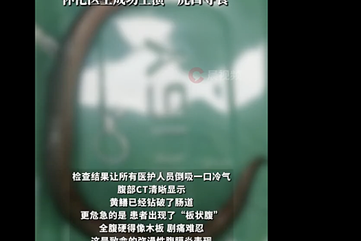 OC: в Китае врачи извлекли из брюшной полости мужчины 30-сантиметрового угря