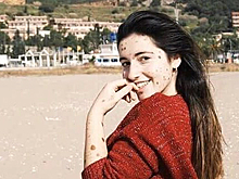 Подвергавшаяся издевательствам из-за родимых пятен испанка стала моделью