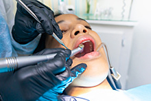 Стоматолог назвал реальные причины для удаления зуба мудрости