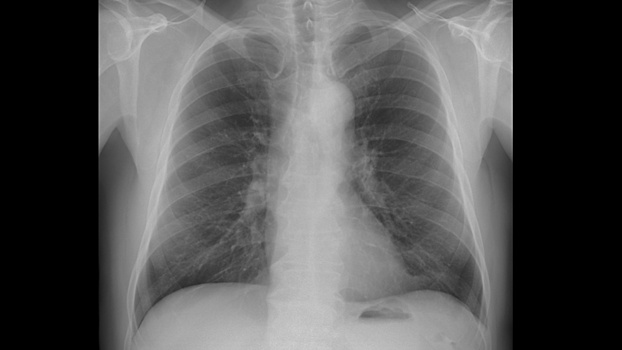 Больше трёх тысяч медицинских снимков вологжан обработал искусственный интеллект