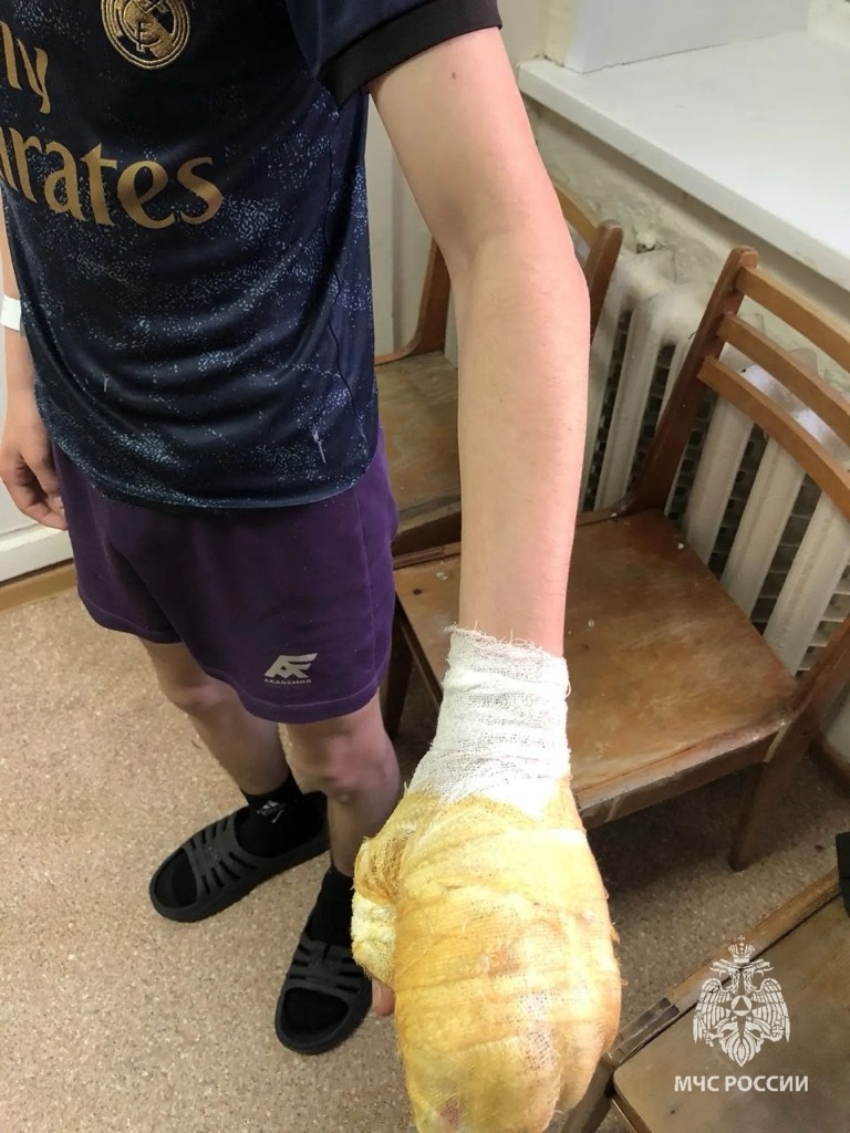 В Ижевске двое детей пострадали от взрывов петард