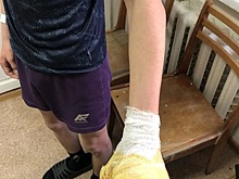 В Ижевске двое детей пострадали от взрывов петард