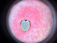 Нижегородка перепутала клеща с папилломой