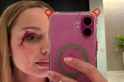 Птица врезалась в девушку-репортера и едва не оставила ее без глаза