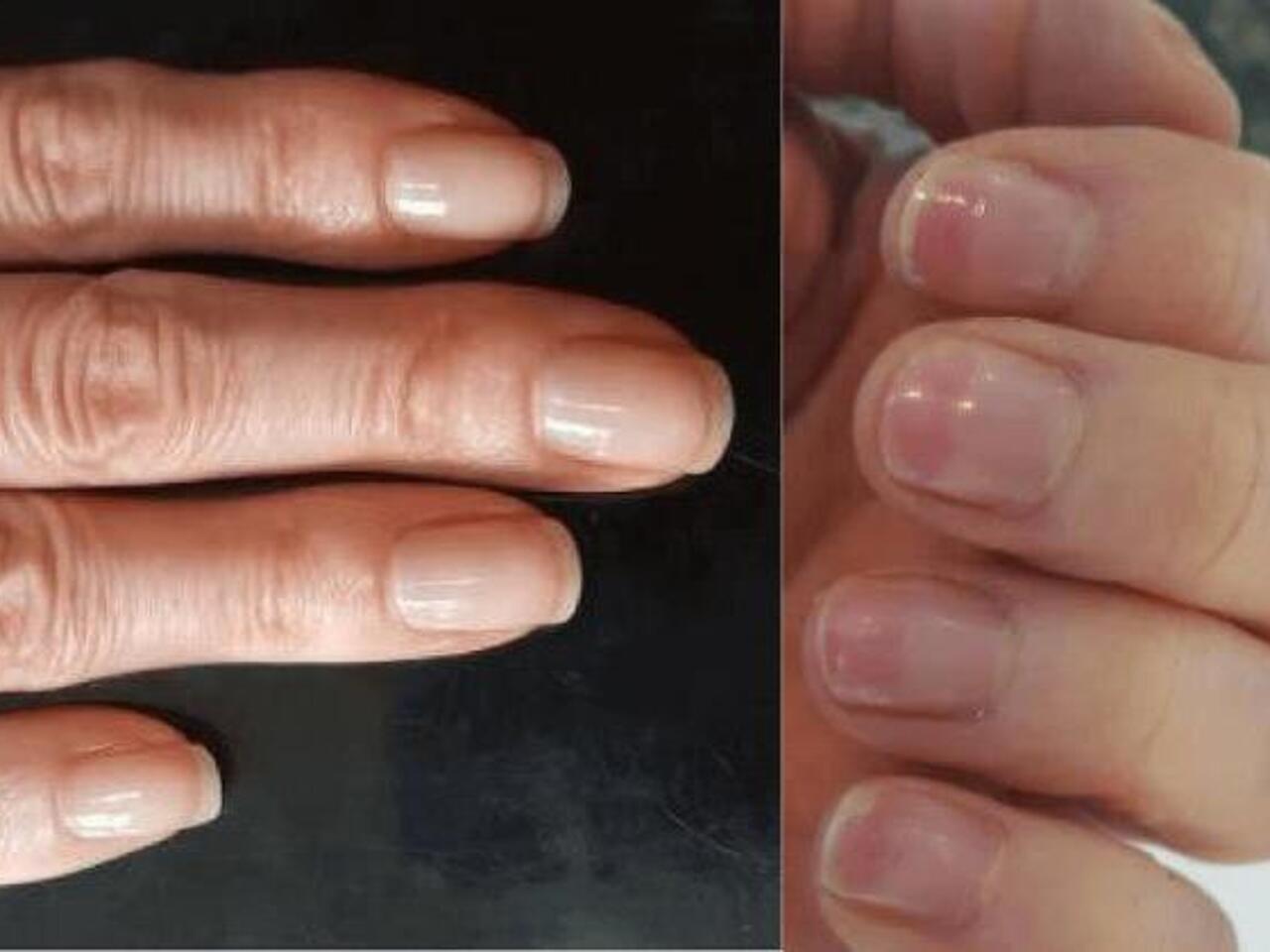 онихолизис синегнойная. тонкие ногти. почему ногти тонкие. почему ногти тонкие. почему ногти тонкие.