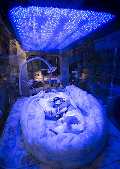 Недоношенный ребенок, родившийся с желтухой, во время светотерапии