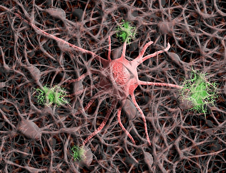 Новые биомаркеры болезни Альцгеймера помогут в его диагностике