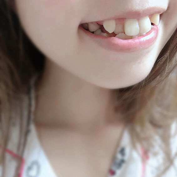 Это сравнительно недавний японский тренд, который называется "йеба", что переводится как "двойные зубы". Суть процедуры состоит в сдавливании клыков двумя соседними коренными зубами, которые выталкивают их вперед. В результате получается эффект настоящих вампирских клыков. Хотя сами японки считают, что становятся похожими на кошечек.