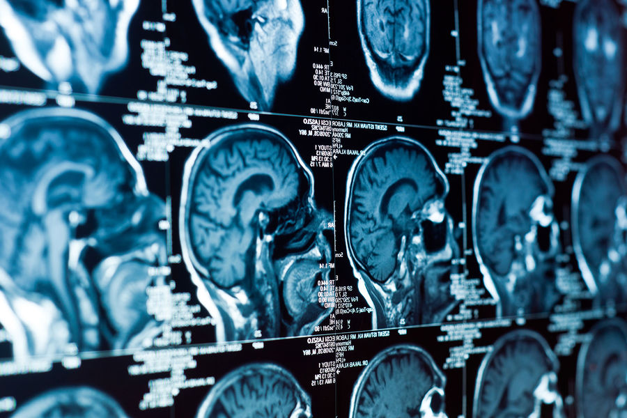 Neuro-Oncology: создан анализ ДНК, определяющий тип опухоли мозга за два часа - EuroPress.news